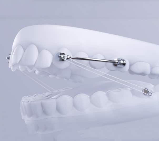 Carriere® Motion™ Appliance